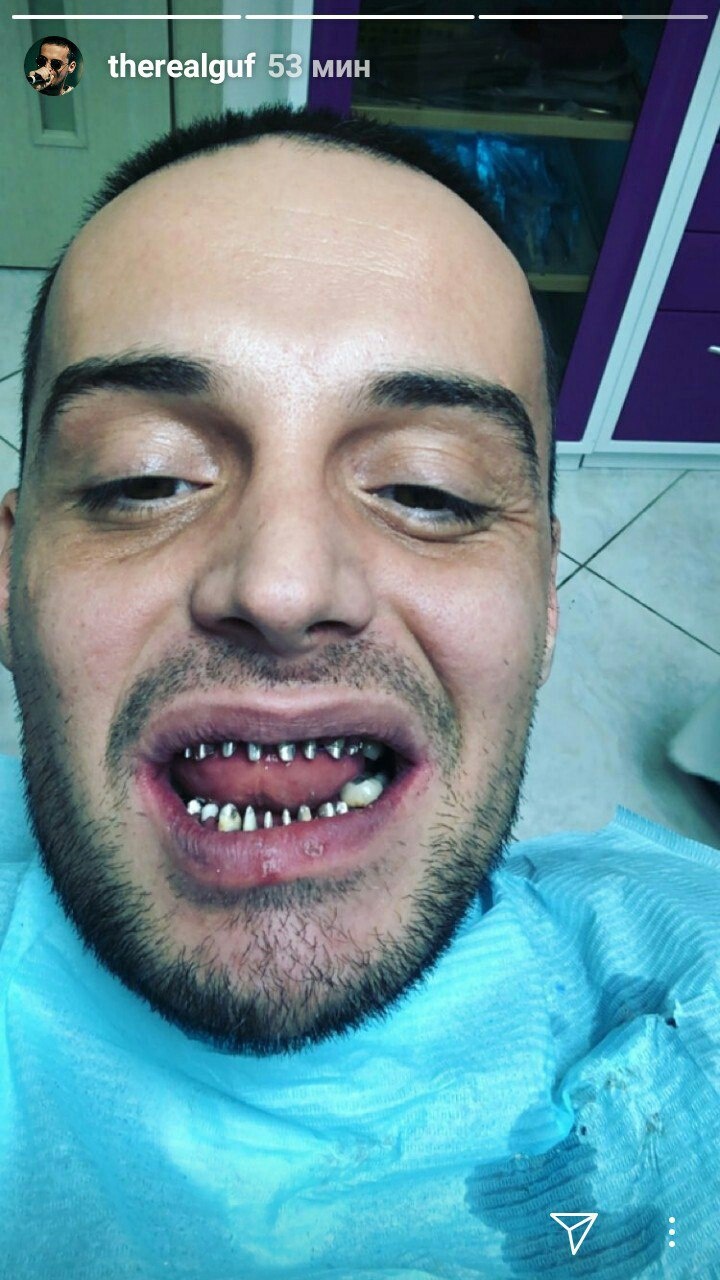 720x1280  Улыбка из имплантатов